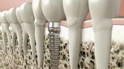 Implanty zębów